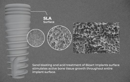 The Ultimate Guide to SLA Surface Implant - Spiral Implant